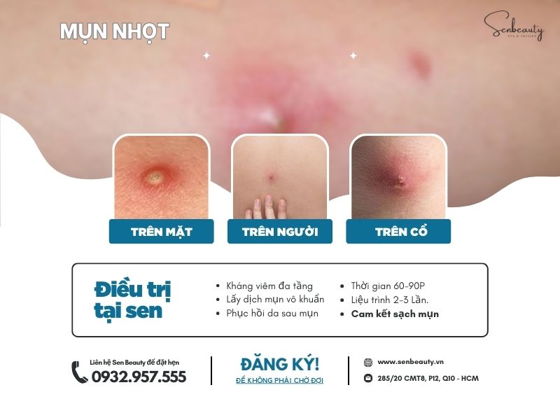 Trị các loại mụn nhọt trứng cá có cam kết